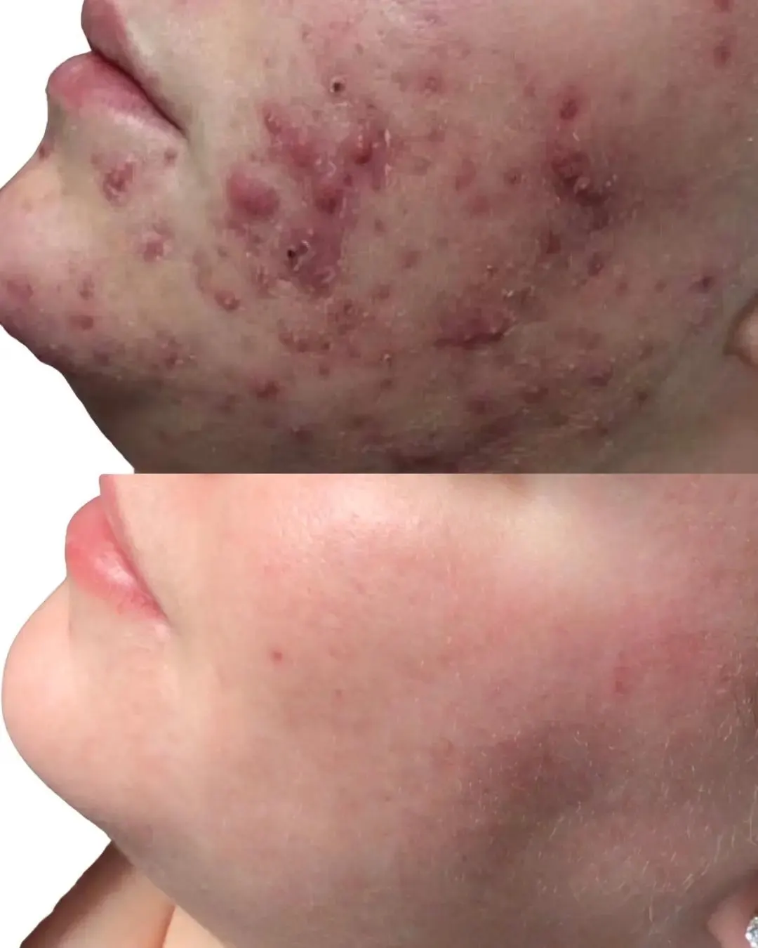 A real client photographed twice: the upper frame shows inflamed spots and redness along the chin and jawline, the lower frame shows much clearer skin in the same area.