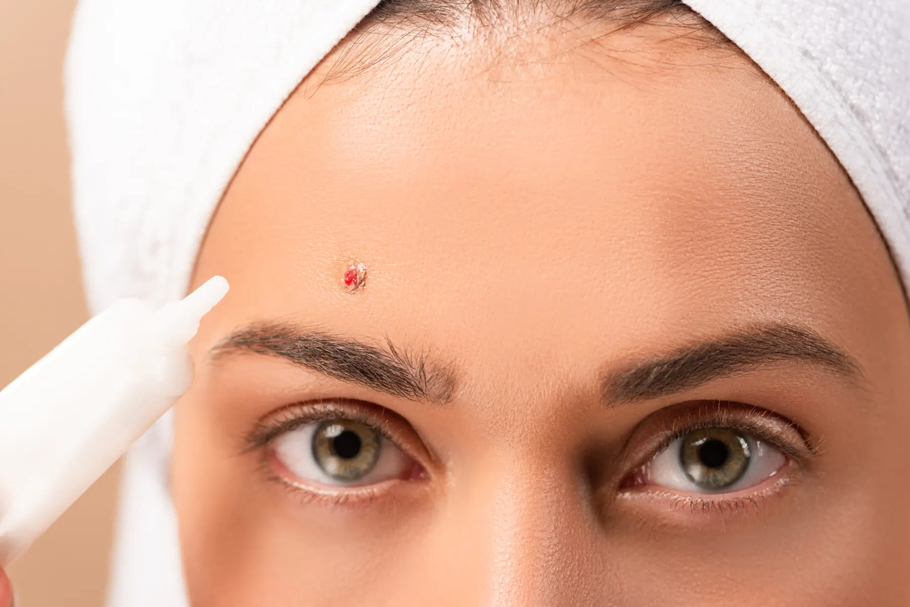 A single inflamed spot on a forehead with a treatment applicator held against it, hair wrapped in a white towel