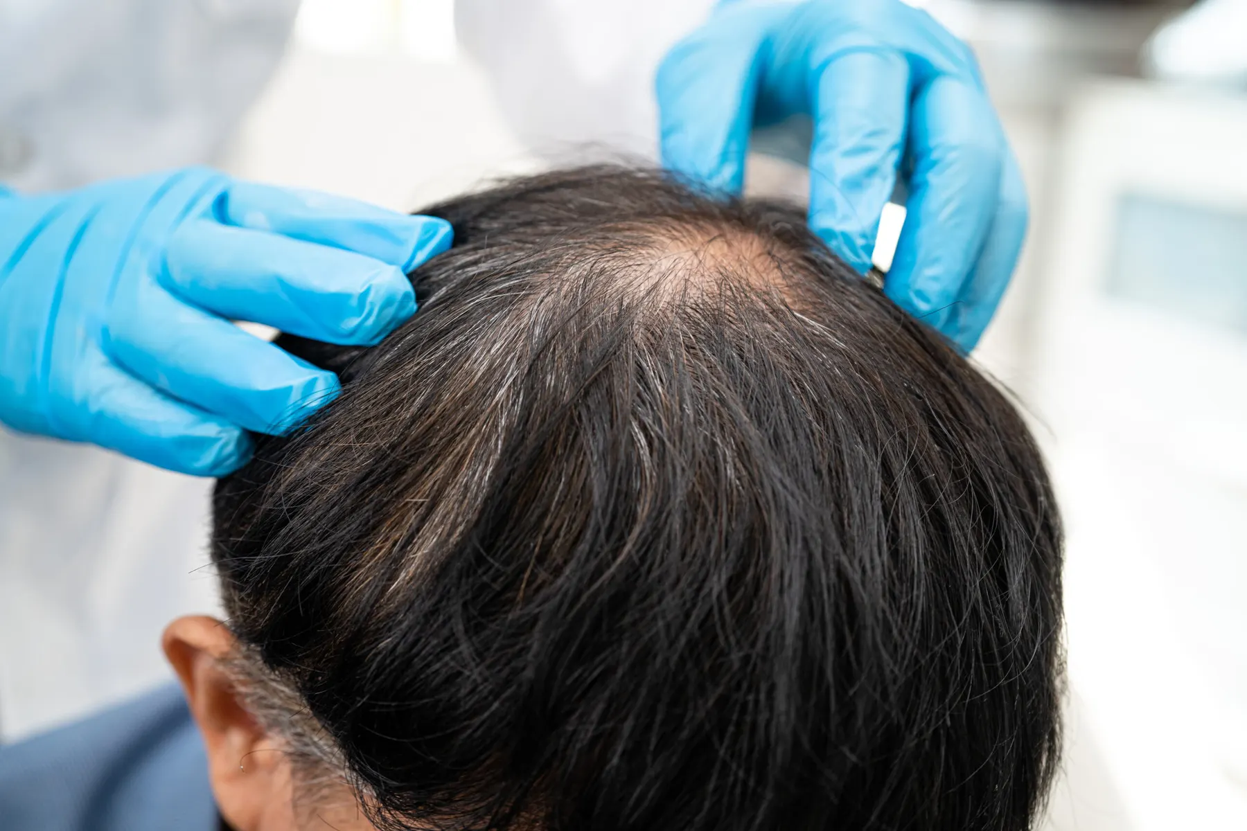 Blue-gloved hands parting a client hair to examine the scalp closely.