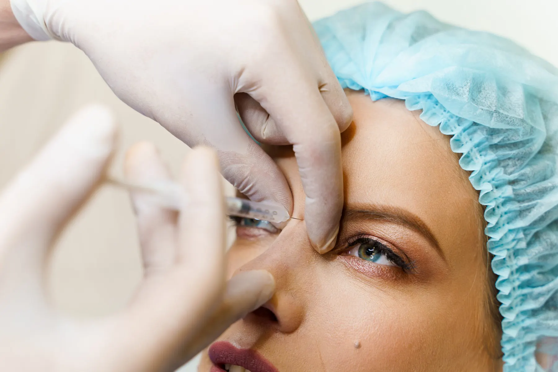 A structural filler injection along the lower face