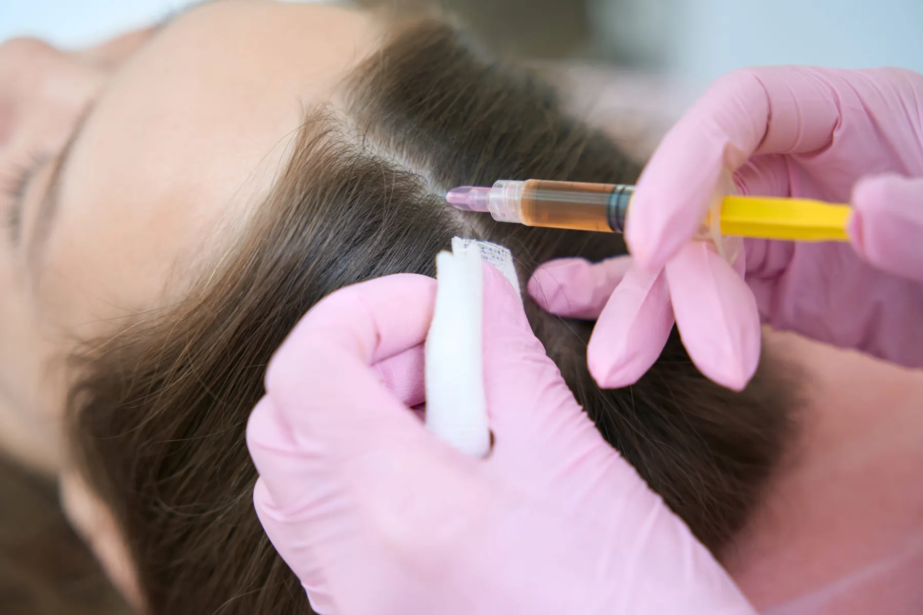 A scalp treatment being carried out with a fine syringe