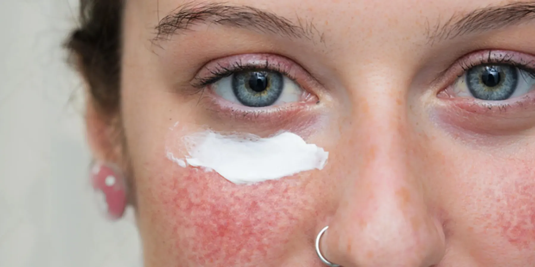 A face showing the diffuse pink flushing across the cheeks and nose that is typical of rosacea