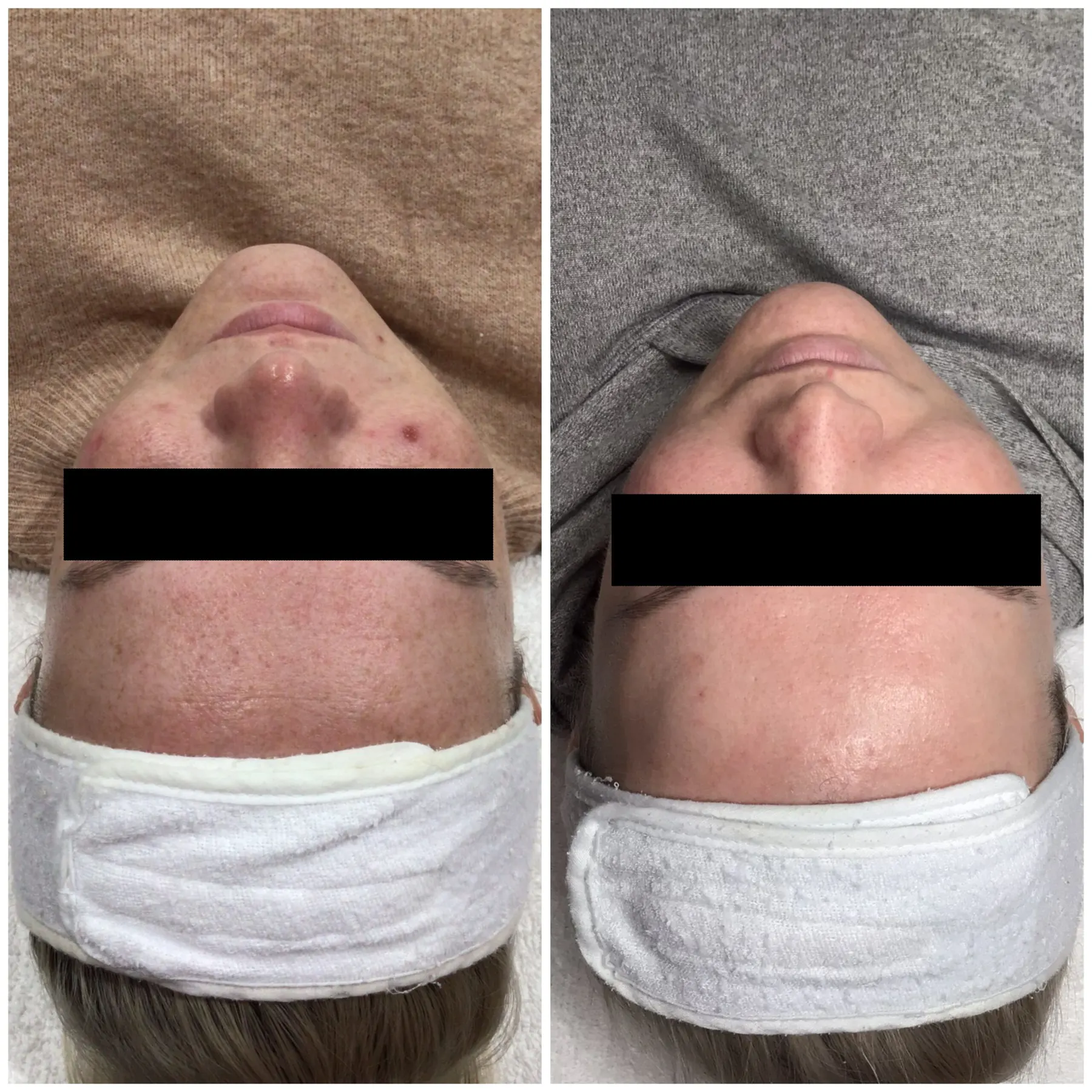 A real client photographed twice with a black privacy bar across the eyes, viewed from above with a white headband in place: dark raised marks across the forehead in the left frame, clear skin in the right frame.
