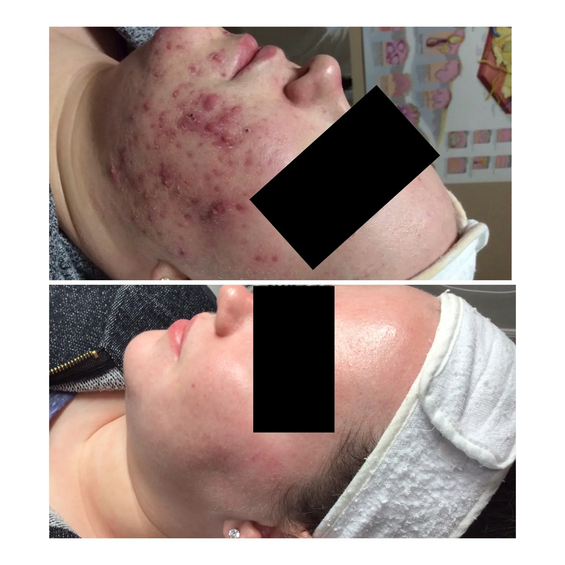 A real client lying down, photographed twice with a black privacy bar across the eyes: densely clustered inflamed spots across the cheek and jaw in the upper frame, largely clear skin in the lower frame.