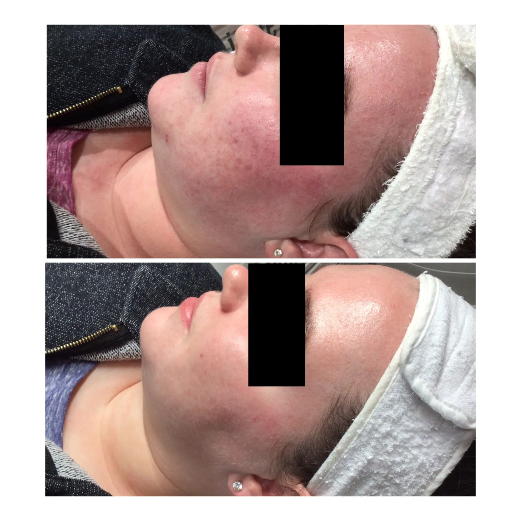A real client lying down, photographed twice with a black privacy bar across the eyes: flushed red skin with visible spots across the cheek and chin in the upper frame, noticeably calmer skin in the lower frame.