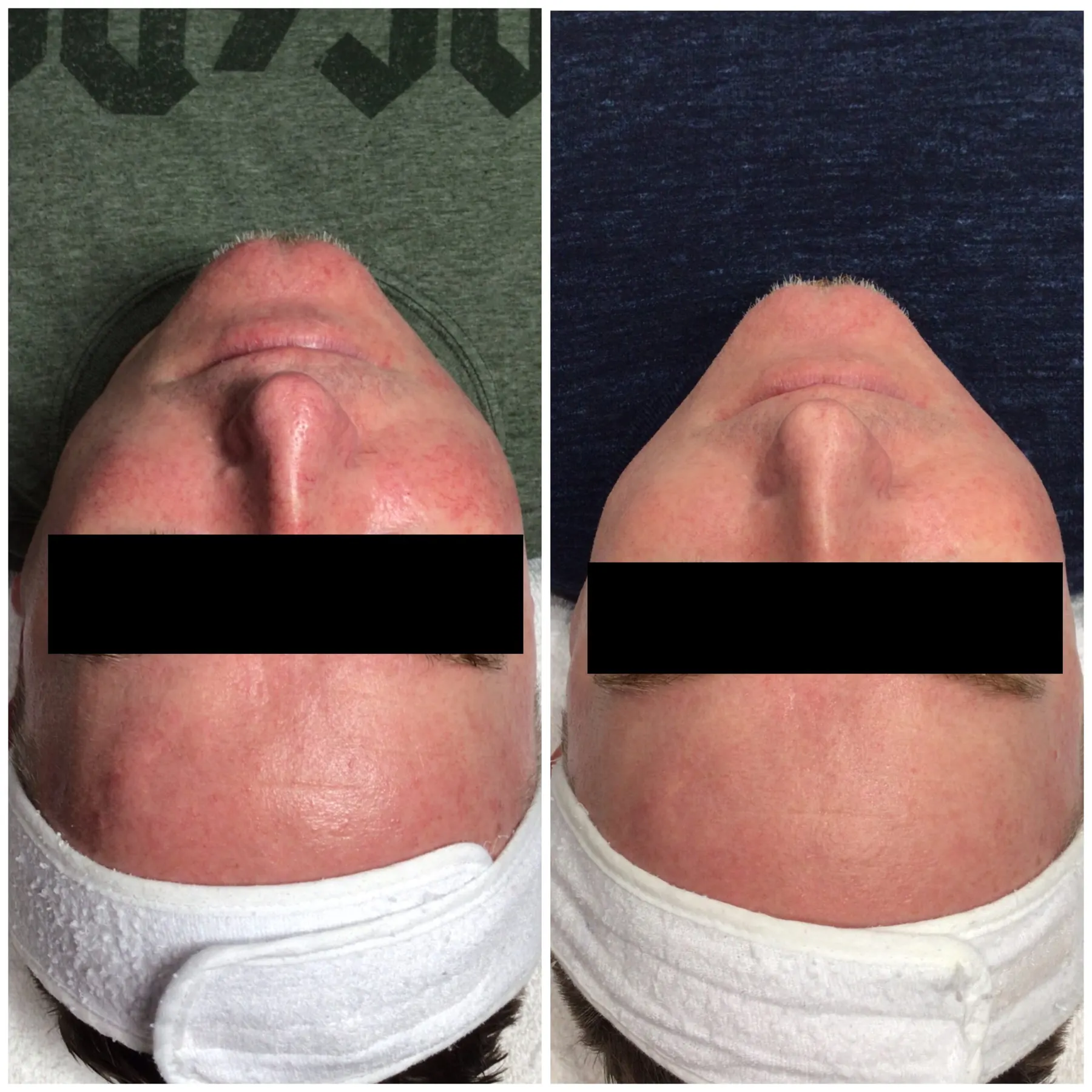 A real client photographed twice from below with a black privacy bar across the eyes: redness and visible surface vessels across the nose and forehead in the left frame, calmer and more even colour in the right frame.