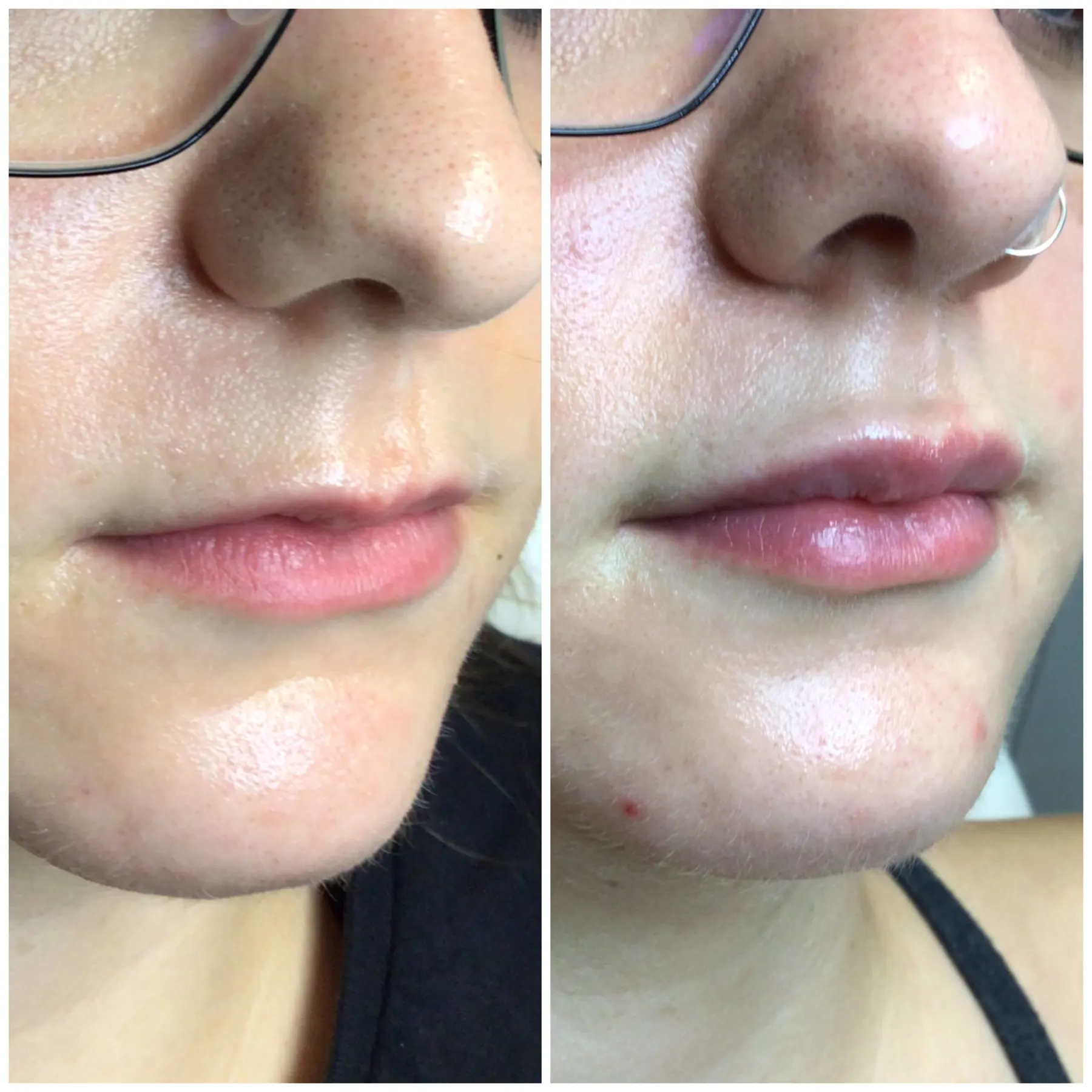 A real client photographed twice side by side from the nose down: the lips are fuller and the border between lip and skin is more defined in the right frame.