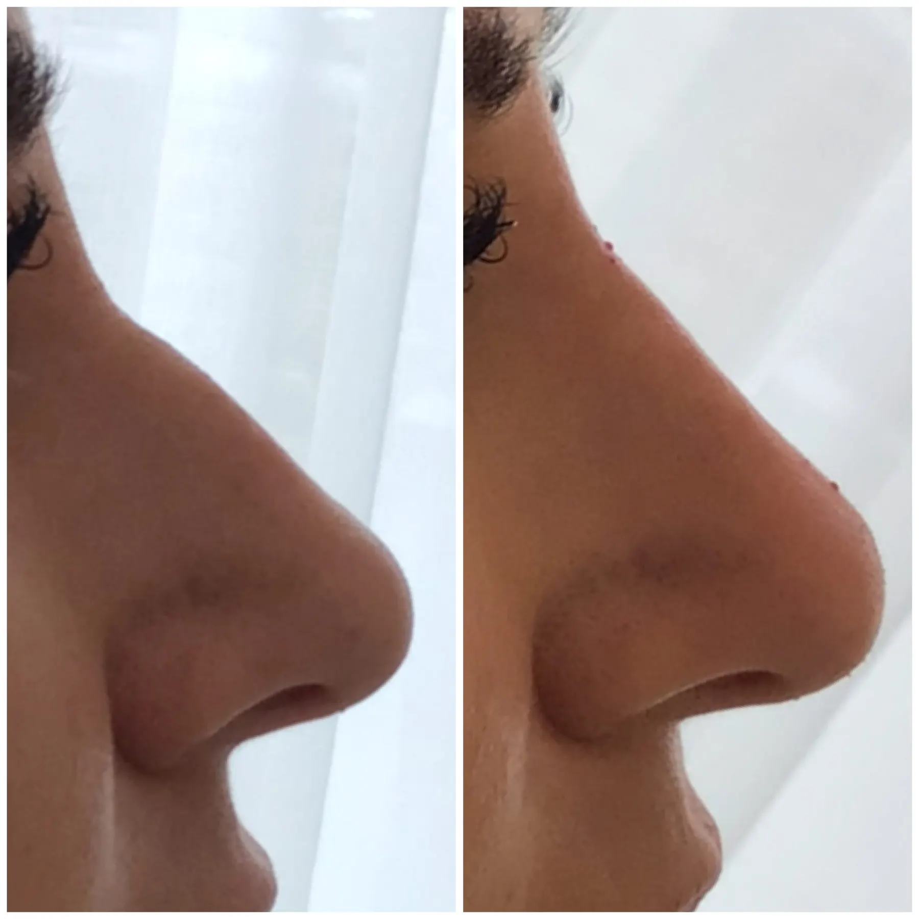 A real client photographed twice in profile against a white blind: the line of the nose runs straighter from bridge to tip in the right frame.