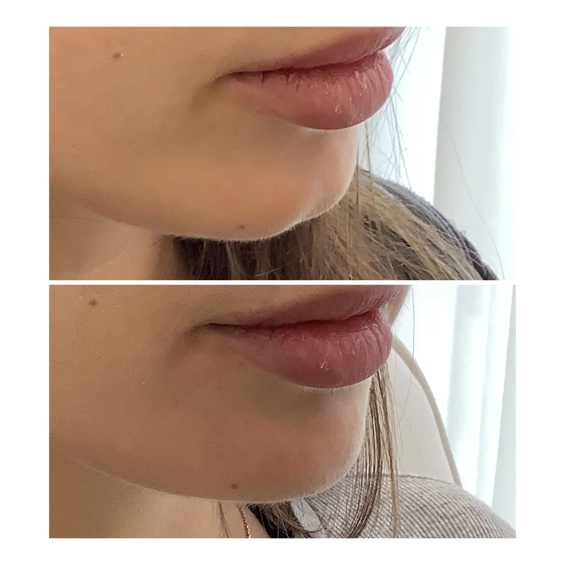A real client photographed twice at a three-quarter angle, cropped from the nose to the neck: the upper and lower lip are fuller and more balanced in the lower frame.