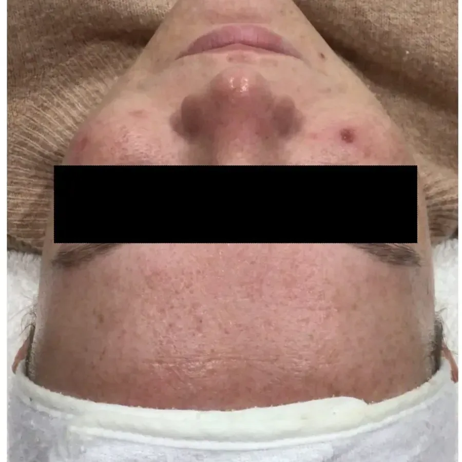 Before treatment for acne at Bradford Skin Clinic