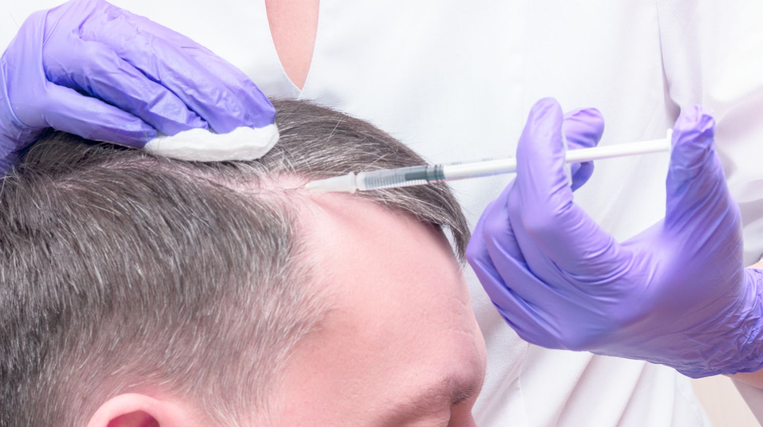 PRP for Hairloss