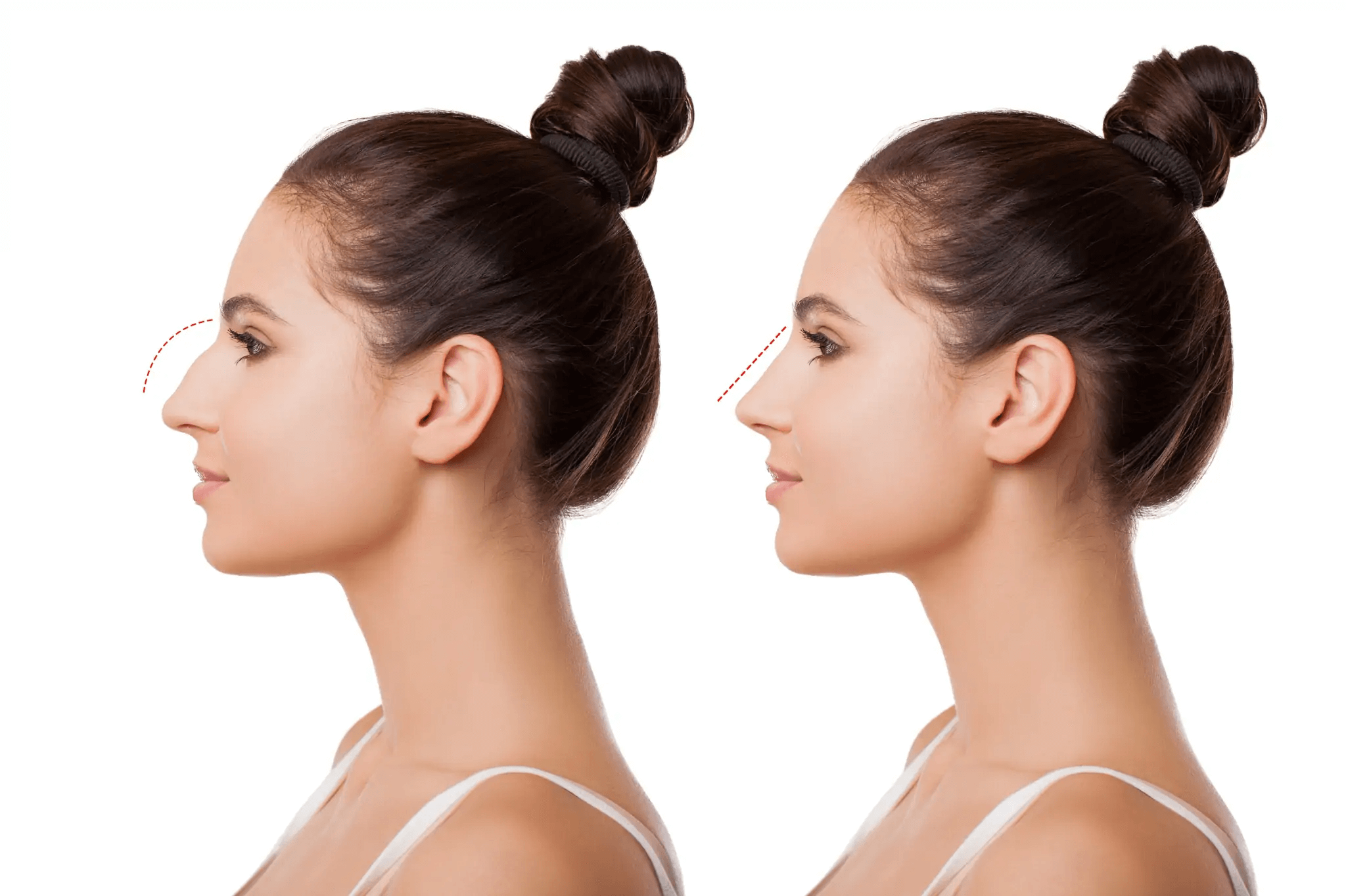 Breathe Easier With Rhinoplasty Bradford Skin Clinic and Medical Spa