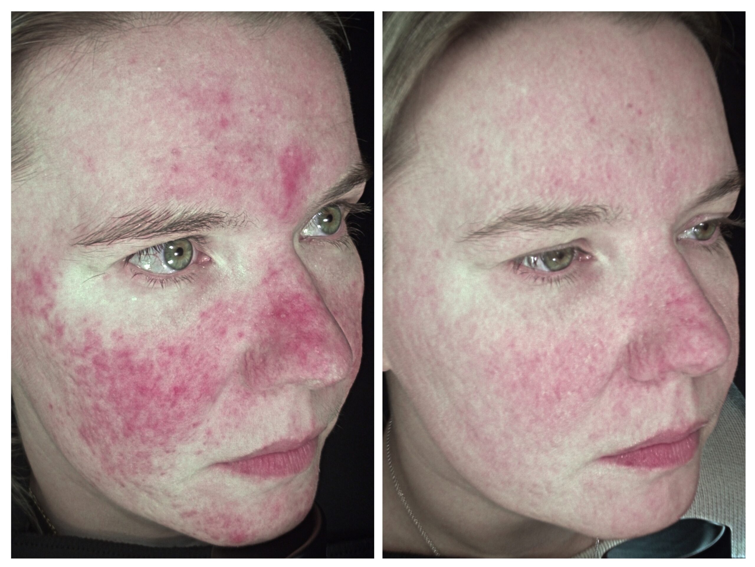 Rosacea Plan