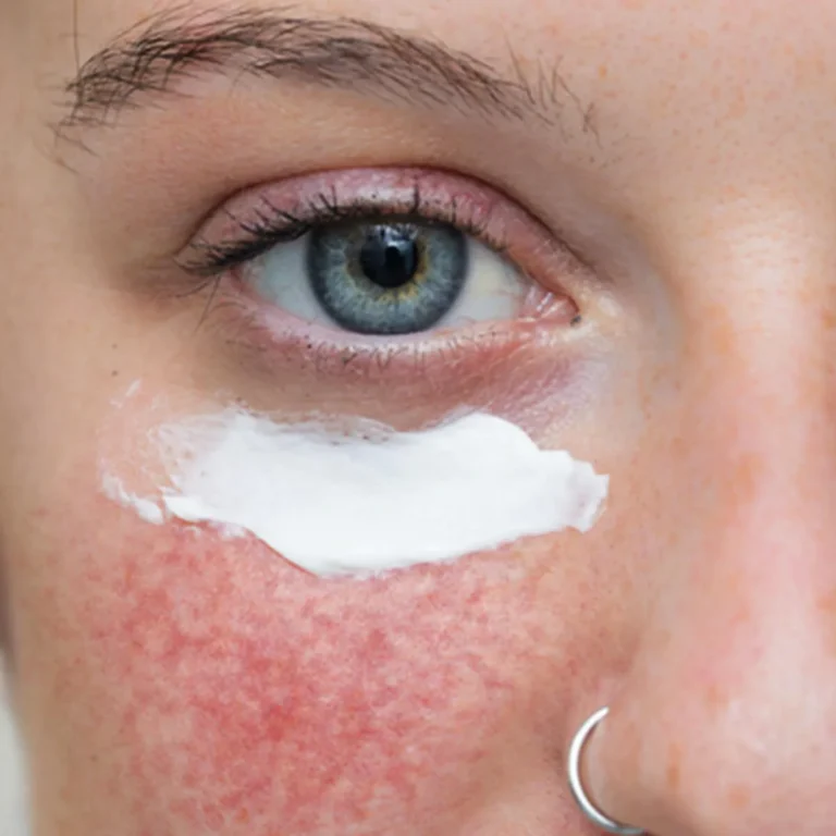 rosacea-skin-care-products-today-091119-main-1_024d200aaf5336b1201c27a03f77c862-jpg