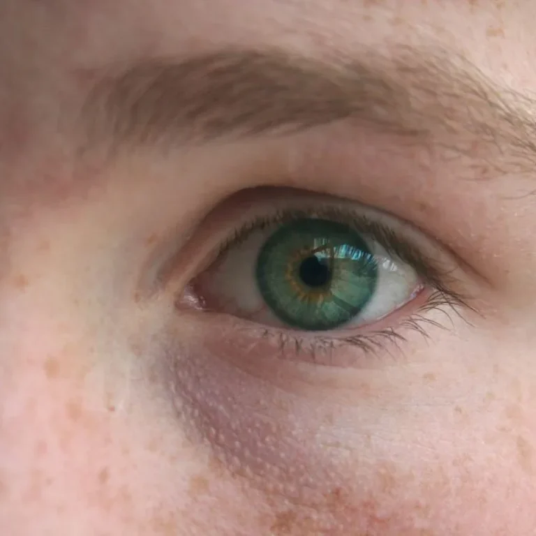 what-are-these-brown-spots-on-m-face-1024x683-1-jpg