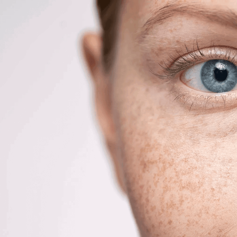 xMelasma-hyperpigmentation.jpg.pagespeed.ic_.idC47AbtBw